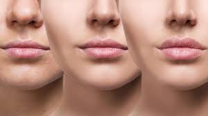 Lip augmentation | Collagen requires an allergy test because the material is extracted from bovine hides. It lasts anywhere...
