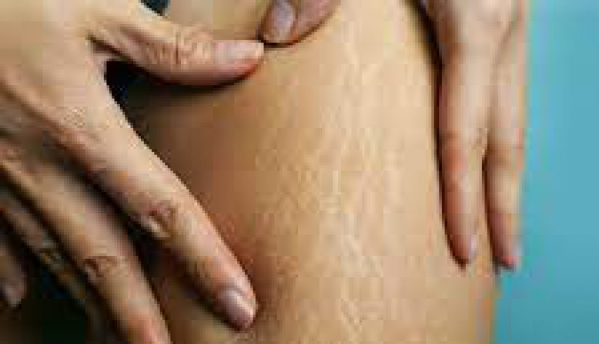 Cellulite is the herniation of subcutaneous fat within fibrous connective tissue that manifests topographically as skin dimpling and...