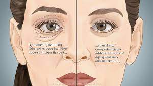 Blepharoplasty is the plastic surgery operation for correcting defects, deformities, and disfigurations of the eyelids; and for aesthetic...